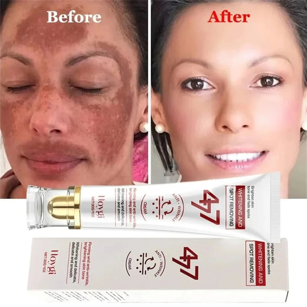 Powerful Spot-Removing Whiten Cream Brighten Skin Fast Eliminates Melanin Pigmentation Melasma Dark Spots Korean Face Skin Care