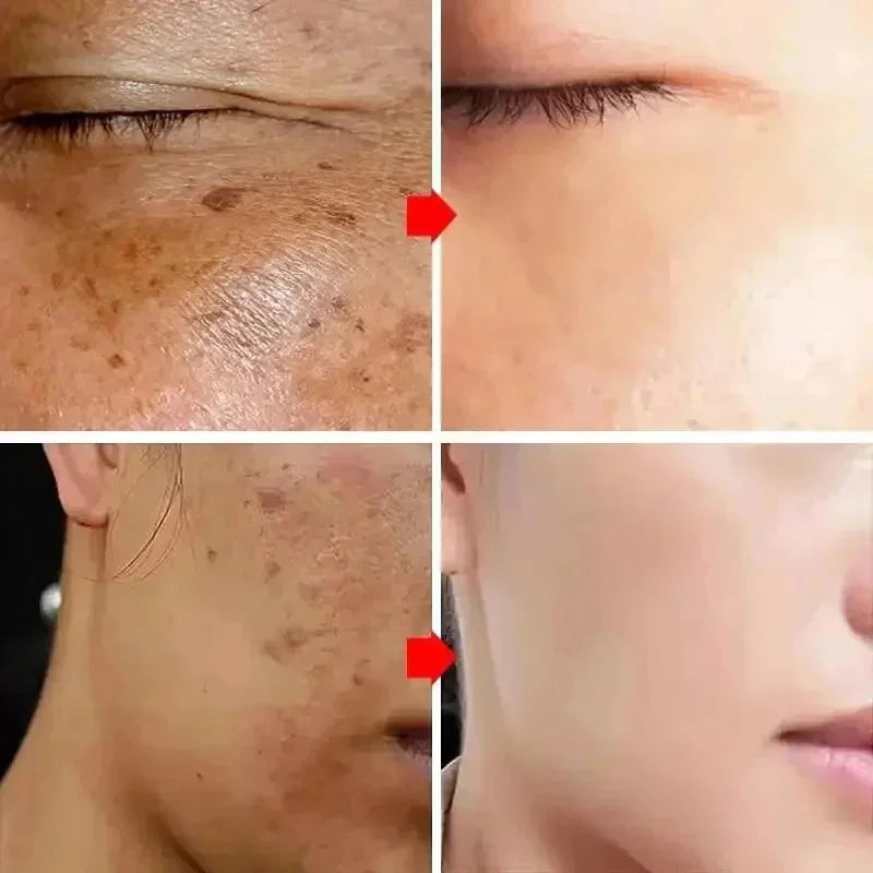 Powerful Spot-Removing Whiten Cream Brighten Skin Fast Eliminates Melanin Pigmentation Melasma Dark Spots Korean Face Skin Care