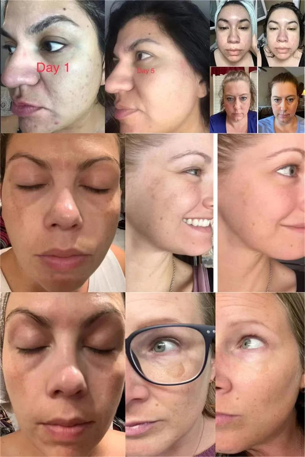 Powerful Spot-Removing Whiten Cream Brighten Skin Fast Eliminates Melanin Pigmentation Melasma Dark Spots Korean Face Skin Care